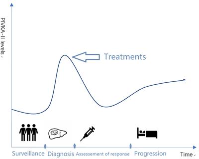 Progression of Prothrombin Induced by Vitamin K Absence-II in Hepatocellular Carcinoma